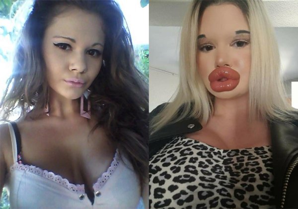 Самые большие губы в мире андреа иванова, Девушка с самыми большими губами, Накаченные губы