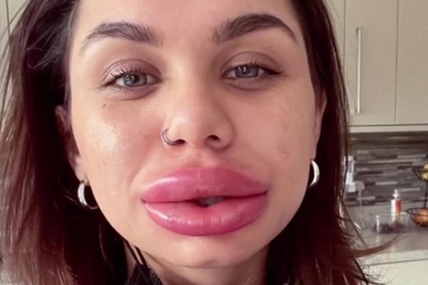 Накачала губы, Накаченные губы, Девушки с накаченными губами красивые