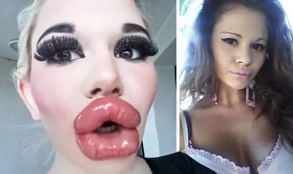 Накаченные губы, Девушки с большими губами, Самые большие силиконовые губы