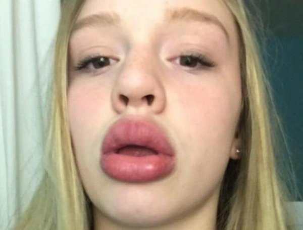 Kylie jenner lip challenge, Накачала губы, Накаченные губы