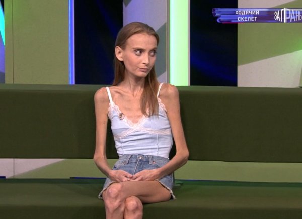 Розалина хусаинова анорексия, Самая худая девушка в мире, Очень худая девушка