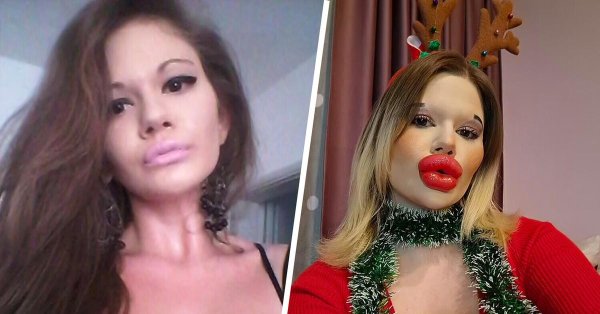 Модель Андреа Иванова с самыми большими губами в мире